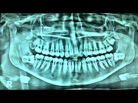 What Is Opg Dental X-ray & How Its Done